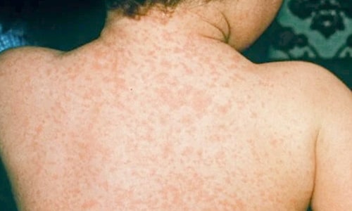 Measles